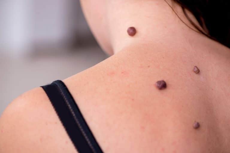 Skin Cancer Know Your Moles